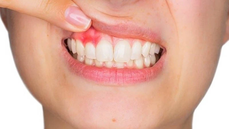 Sau khi nhổ răng bao lâu thì trồng implant là thích hợp? 1