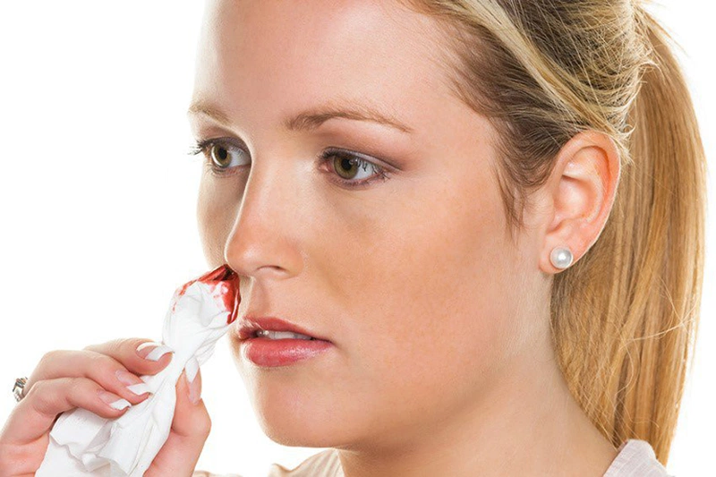 Mũi bị chảy máu - biến chứng khác sau nâng mũi