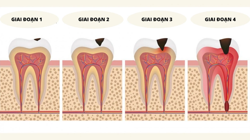 Điều trị sâu răng hàm ở từng giai đoạn