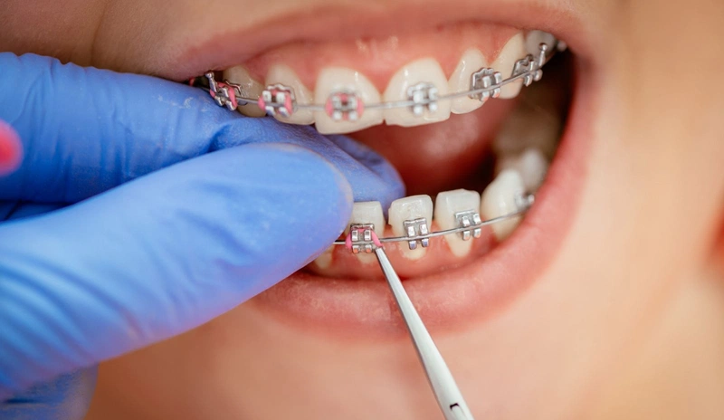 Sâu răng khi niềng răng: Cần lưu ý những điều gì? 3