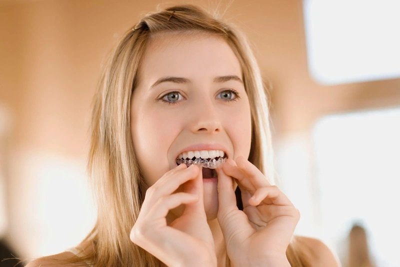 Sau sinh bao lâu thì niềng răng được? Lưu ý trước khi niềng răng sau sinh? 2
