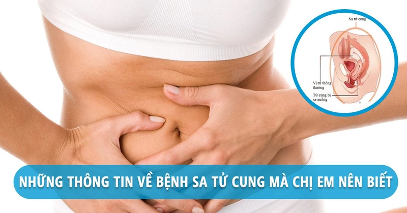 Sau sinh mổ có bị sa tử cung không?