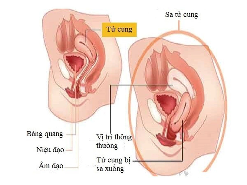 ​  Sau sinh mổ có bị sa tử cung không và những điều cần biết  ​