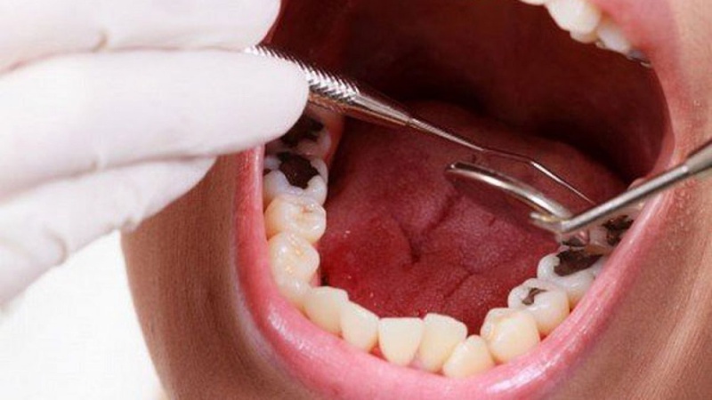 Áp xe răng - Nguyên nhân, triệu chứng, cách điều trị và phòng ngừa hiệu quả 2