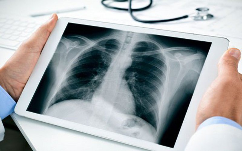 Chụp Xquang phổi là một trong những phương pháp chẩn đoản