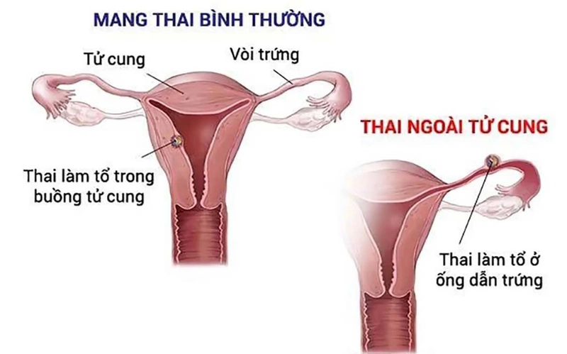 Siêu âm đầu dò có phát hiện thai ngoài tử cung không?1