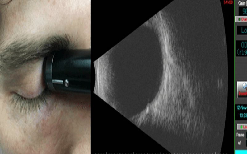 Siêu âm mắt là phương pháp sử dụng tần số cao và hệ thống âm thanh của thiết bị đặc biệt để tạo ra hình ảnh chi tiết của mắt