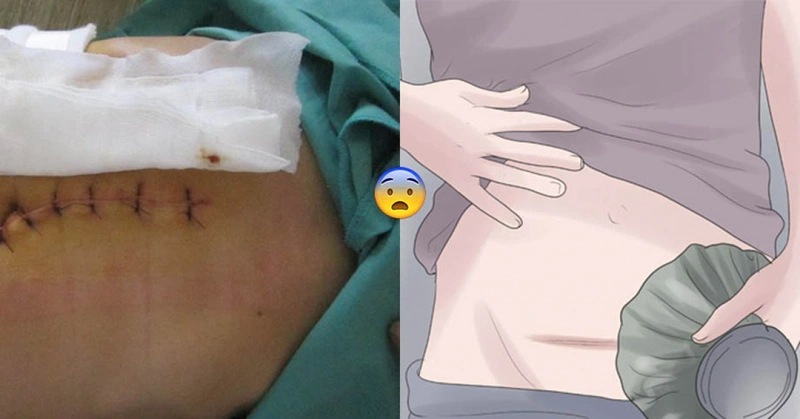 Sinh mổ 1 năm có bầu lại được không?
