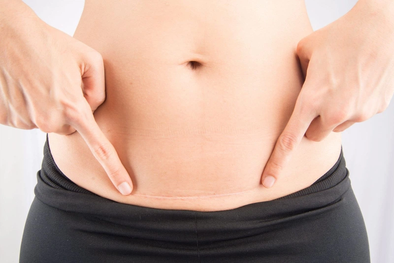 Sinh mổ lần 2 liệu có nguy hiểm không? Những lưu ý sản phụ nên biết 1