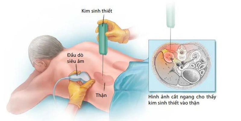 Sinh thiết thận là gì? Những điều cần biết trước khi thực hiện 1