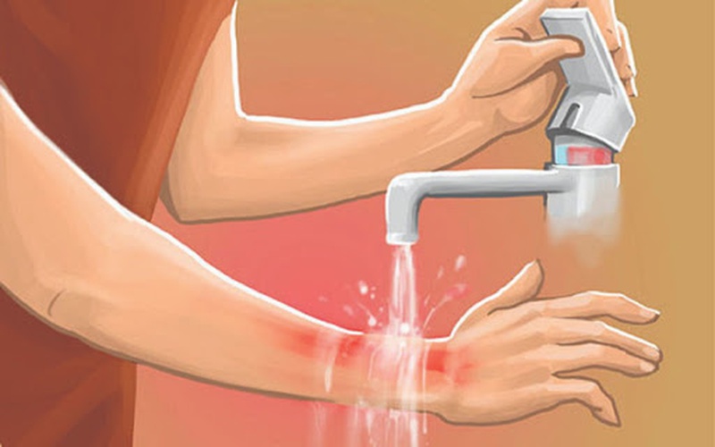 Sơ cứu bỏng đúng cách nhất như thế nào? 3