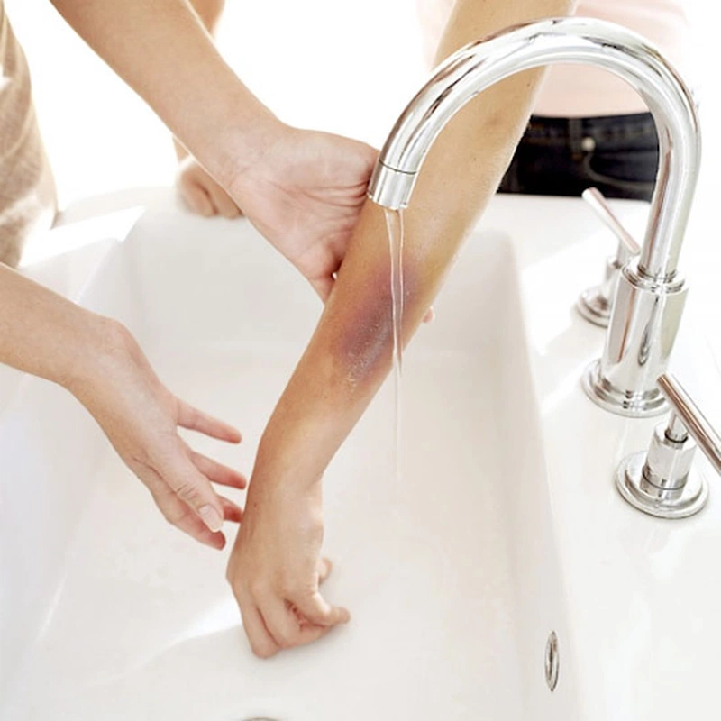 Sơ cứu bỏng bằng kem đánh răng có thực sự hiệu quả đối với các vết thương từ nhẹ đến nặng? 1