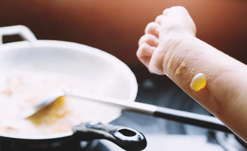 Sơ cứu bỏng dầu  và những điều bạn không thể bỏ qua 3