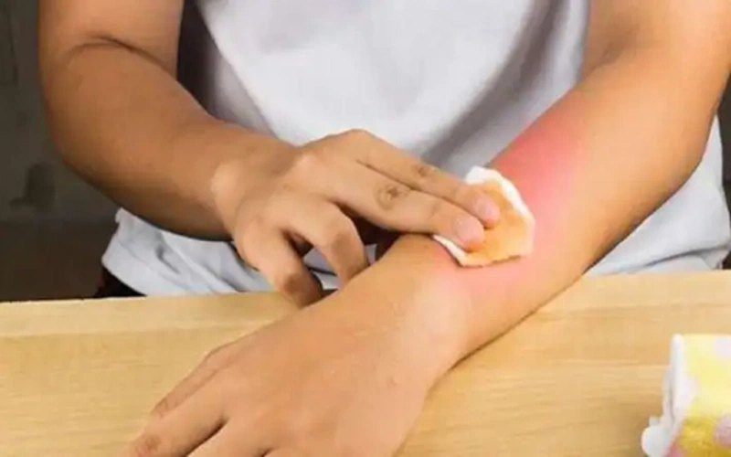 Bỏng da cấp độ 1 ở trẻ em thường tự khỏi sau 2 tuần chăm sóc tại nhà, thường không để lại sẹo