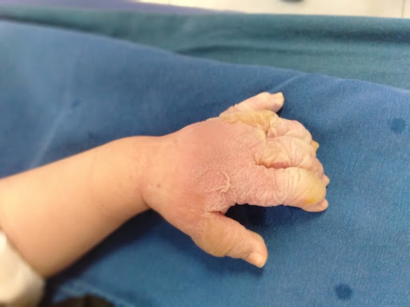 Mách bạn cách sơ cứu khi bé bị bỏng chuẩn nhất 1