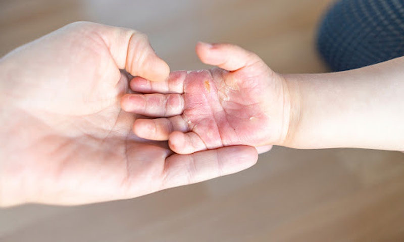 Mách bạn cách sơ cứu khi bé bị bỏng chuẩn nhất 2