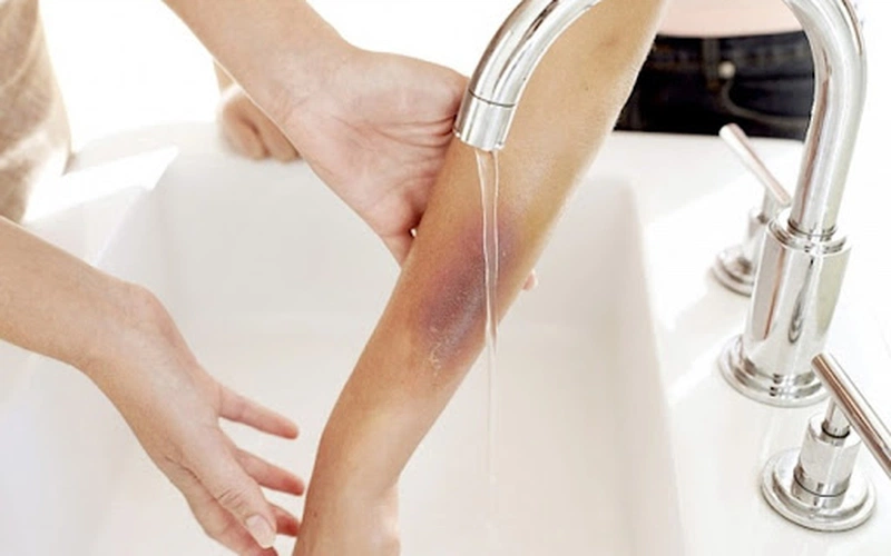Mách bạn cách sơ cứu khi bé bị bỏng chuẩn nhất 3