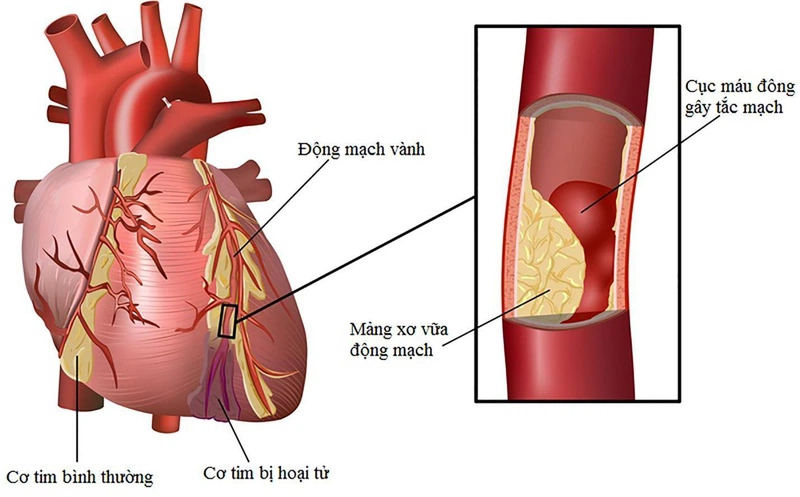 Người bệnh sẽ dễ bị rơi vào tình trạng nhồi máu cơ tim nếu một trong hai động mạch nuôi tim bị tắc nghẽn hoàn toàn