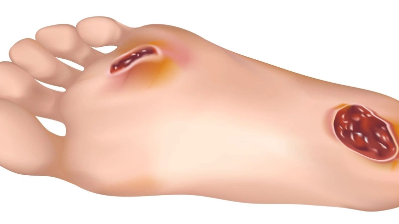 Sơ cứu vết thương ở lòng bàn chân 1