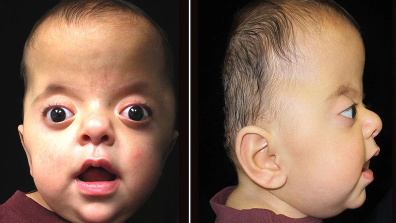 So sánh bệnh bướu cổ và bệnh bazodo ở người - Điểm giống và khác nhau 3