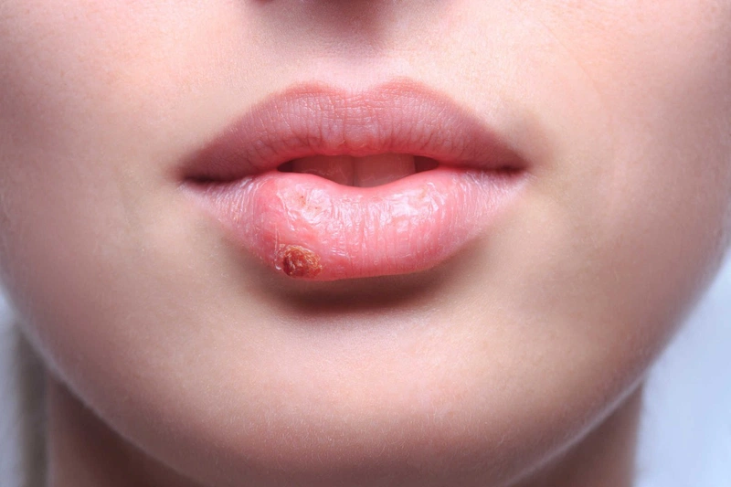 So sánh phun môi pha lê và phun môi collagen. Nên chọn kỹ thuật nào? 3