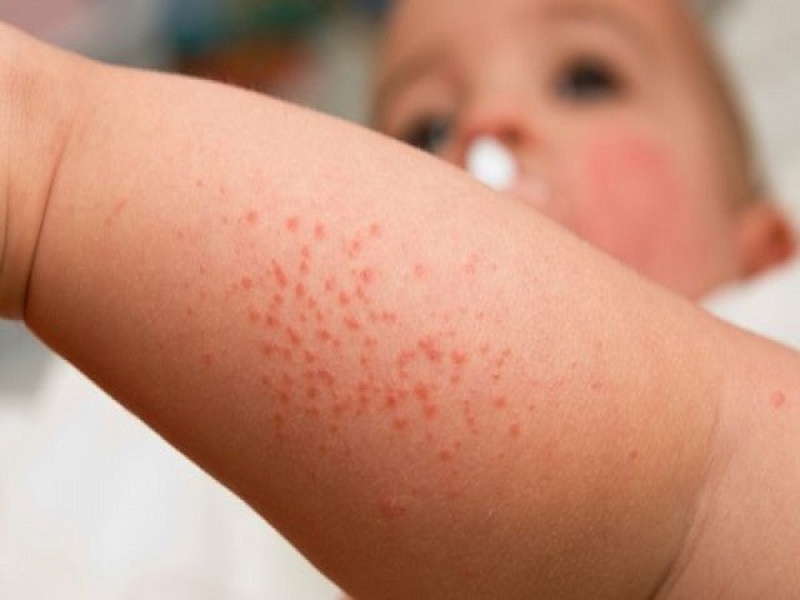 So sánh sốt phát ban và sởi 1