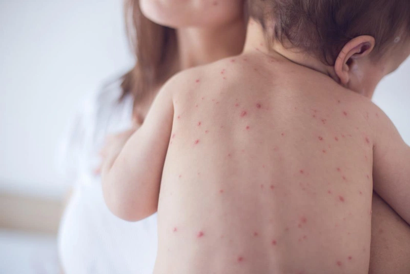 Sởi chạy vào trong gây nguy hiểm như thế nào 1?