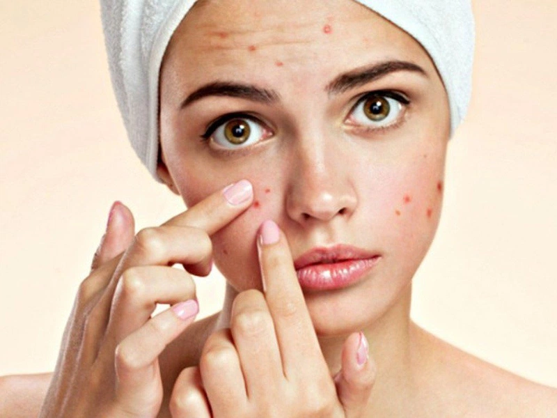 Sởi khác thủy đậu ở những điểm nào? 3