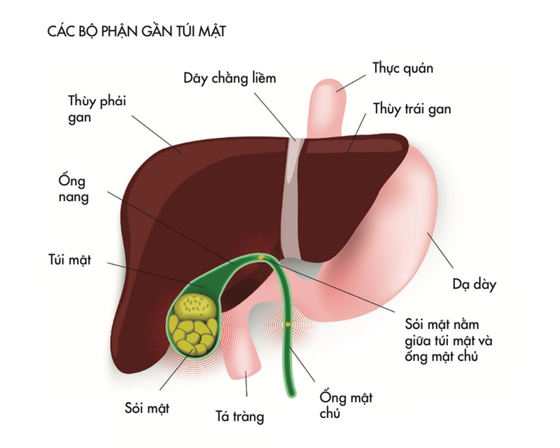 Sỏi mật có nguy hiểm không biến chứng của sỏi túi mật 1