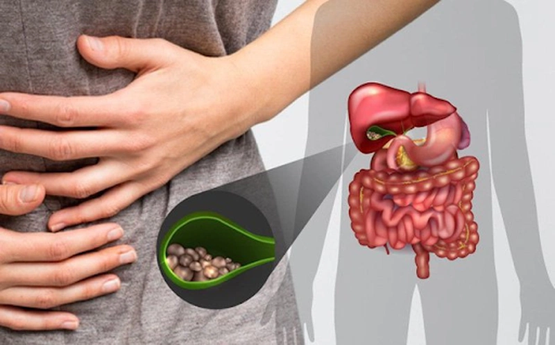 Góc giải đáp: Sỏi mật có mấy loại?