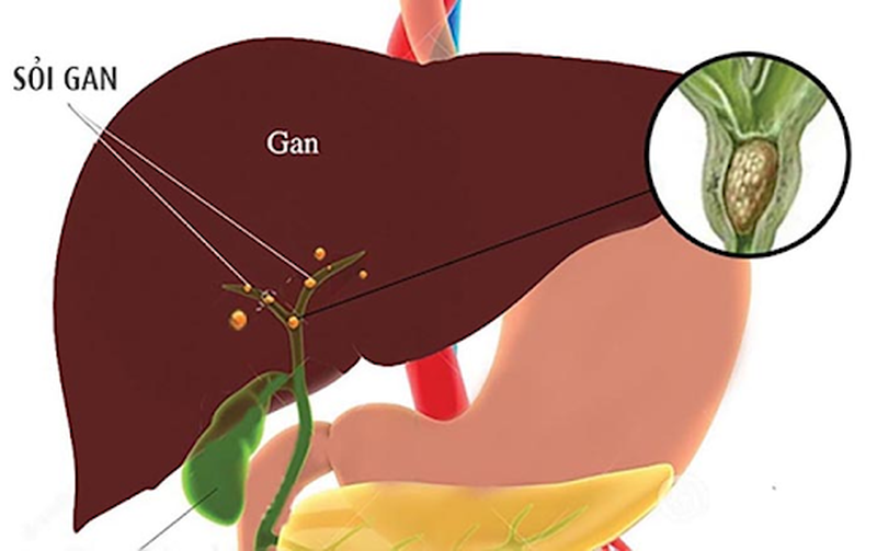 Góc giải đáp: Sỏi mật gan là gì?