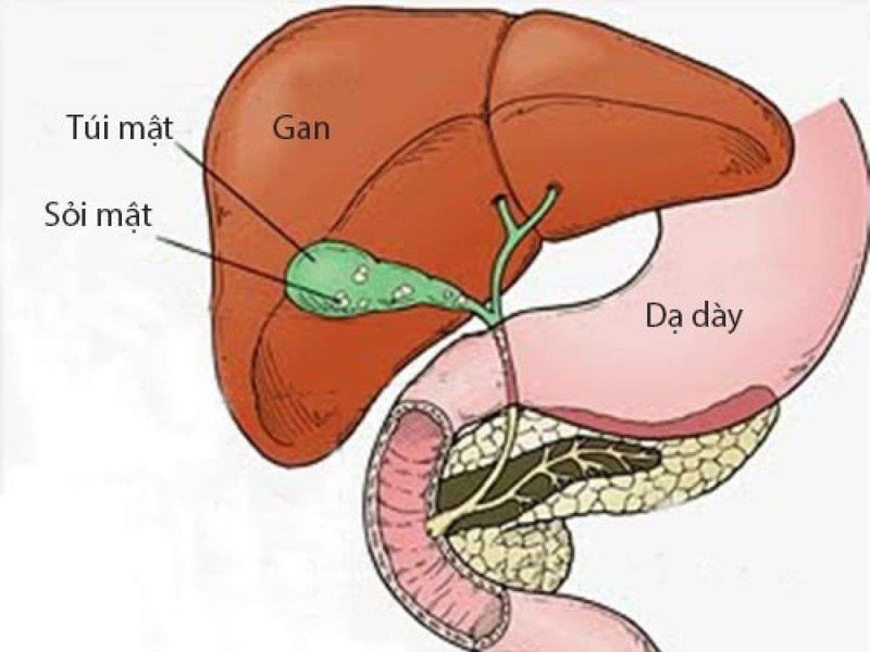 sỏi mật gây đau bụng ra sao dấu hiệu nhận biết và cách giảm đau 1