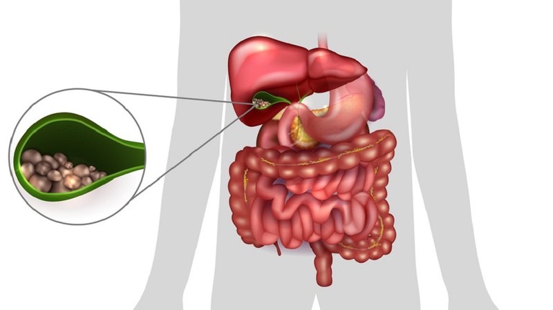 Sỏi mật hình thành như thế nào? Cơ chế là khác nhau ở từng loại sỏi