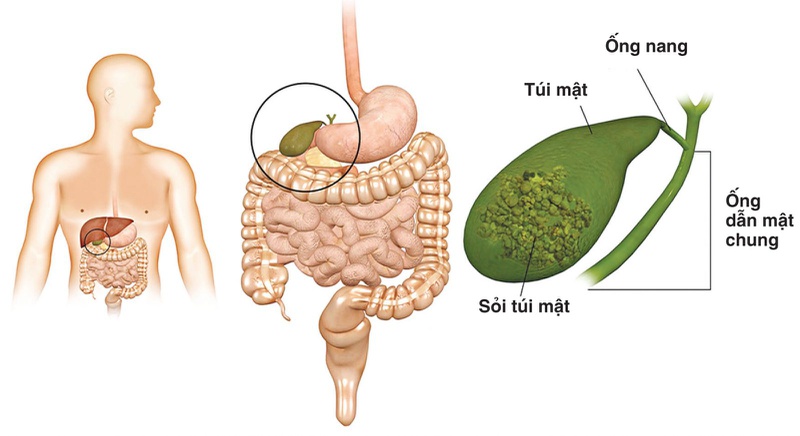 Sỏi mật khi mang thai có nguy hiểm không 1