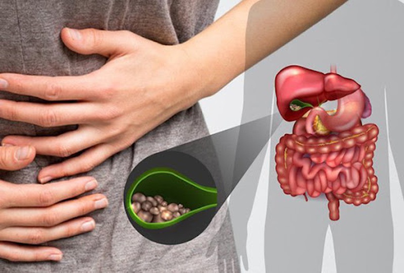Sỏi Mật Ở Nam Giới Xuất Phát Từ Đâu Và Có Những Triệu Chứng Nào? 2