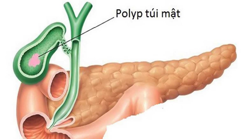 Khi nào cần điều trị sỏi mật Polyp 1
