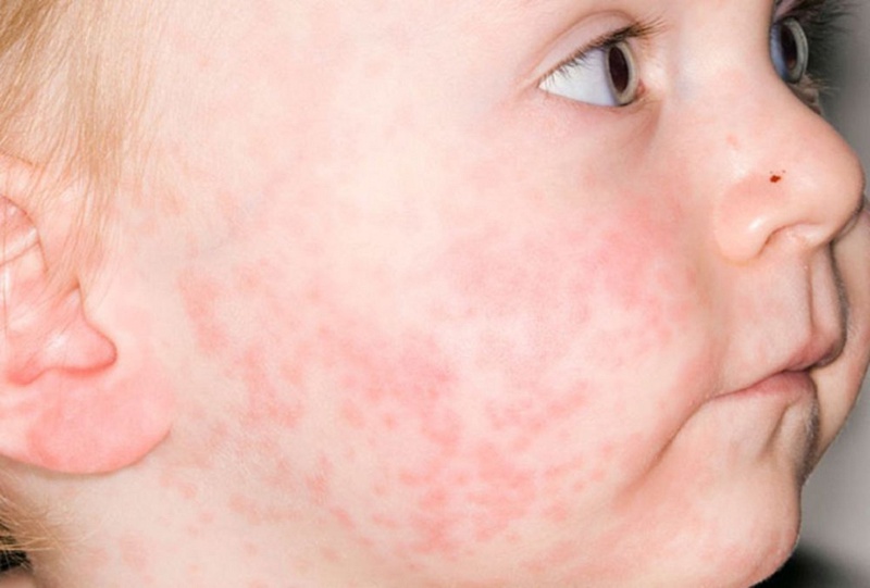 Cảnh giác với những biến chứng bệnh sởi ở trẻ em 1