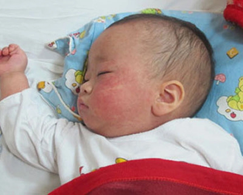 Cảnh giác với những biến chứng bệnh sởi ở trẻ em 2