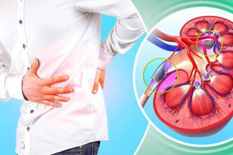 Trả lời thắc mắc: Sỏi thận uống bia được không? 1