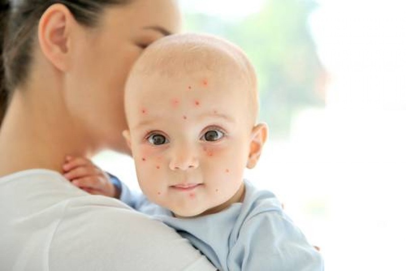 Cách phân biệt sởi và thủy đậu chính xác nhất 2