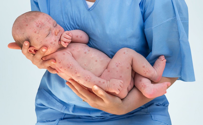 Phân biệt sốt phát ban khác sởi như thế nào 1
