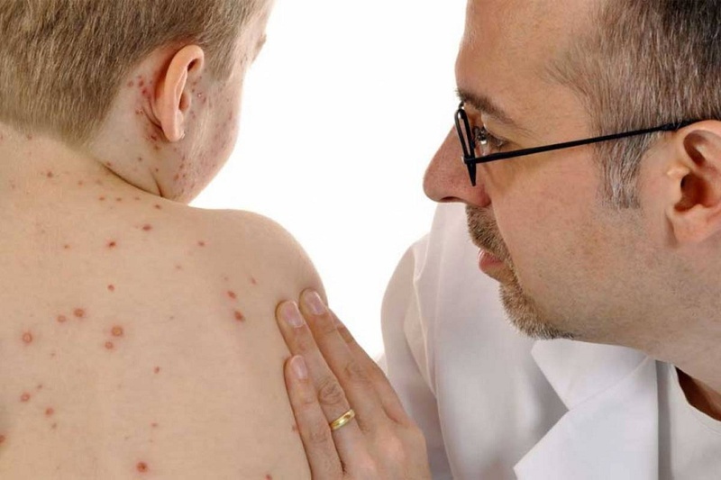 Phân biệt sốt phát ban và thủy đậu chưa bao giờ đơn giản đến thế 2