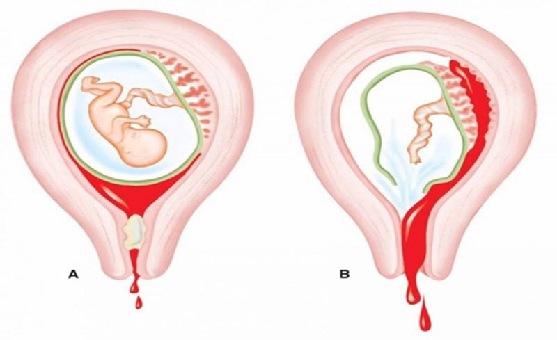 Sót rau sau sảy thai có nguy hiểm không? 1