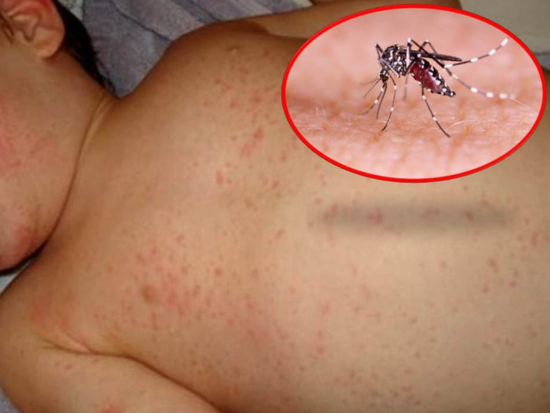 Sốt xuất huyết ngày thứ mấy là nguy hiểm nhất? Coi chừng biến chứng nặng 2