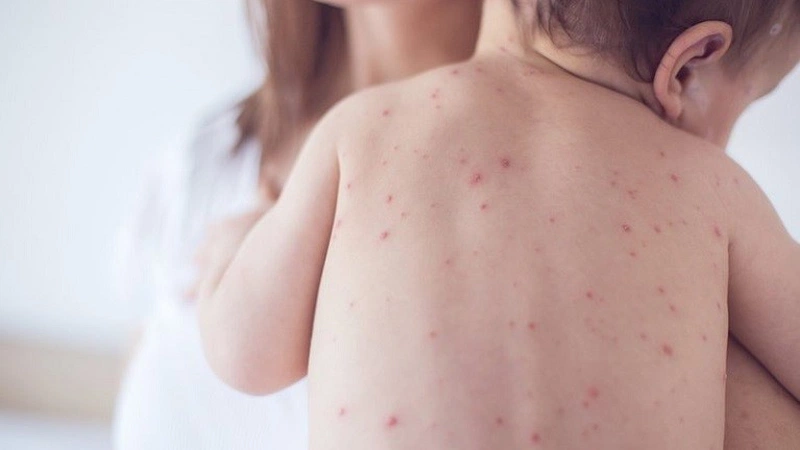 Sốt xuất huyết nổi mẩn đỏ có sao không? Làm sao xử lý? 2