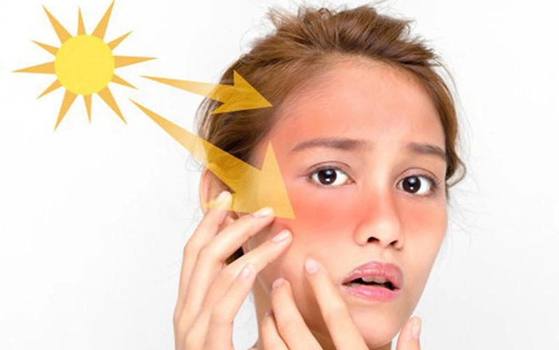 Tia UV có thể dây sạm da, nám và tàn nhang