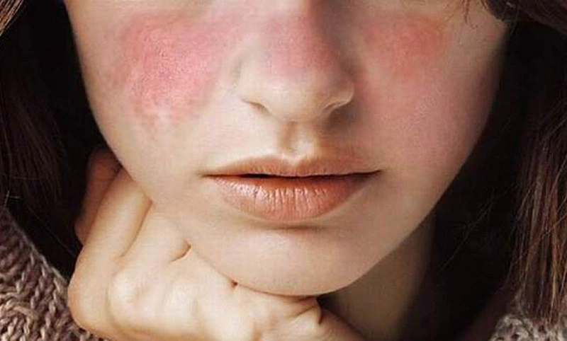 Gợi ý cho bạn một số thuốc bôi lupus ban đỏ dạng đĩa hiệu quả 3