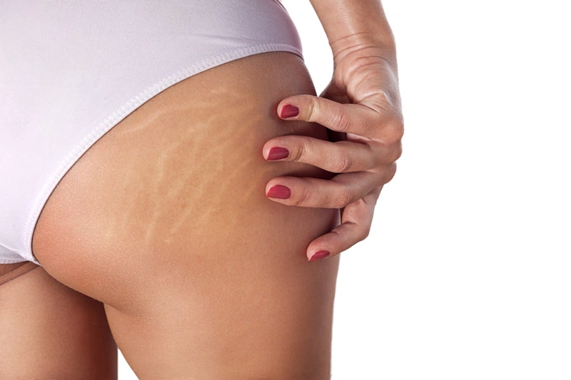 Công dụng mà dầu trị rạn da mang lại có thật sự hiệu quả?1