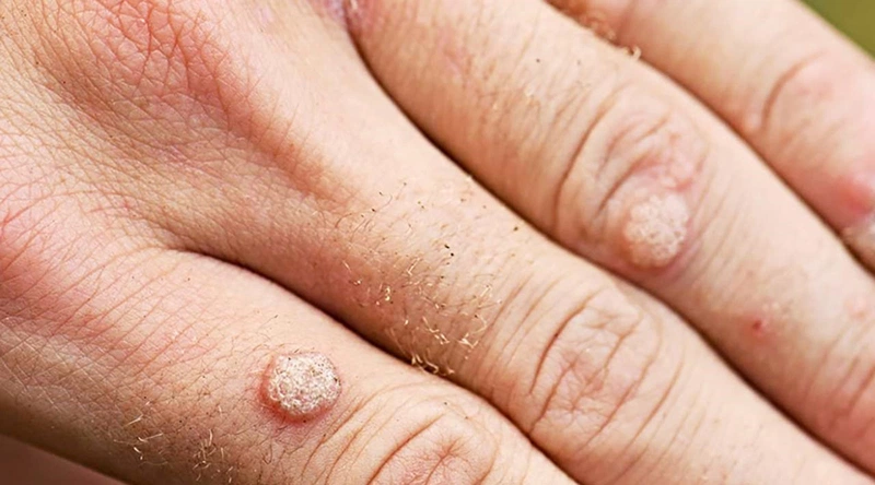 Vài nét về phương pháp sử dụng trái nhàu trị mụn cóc 5