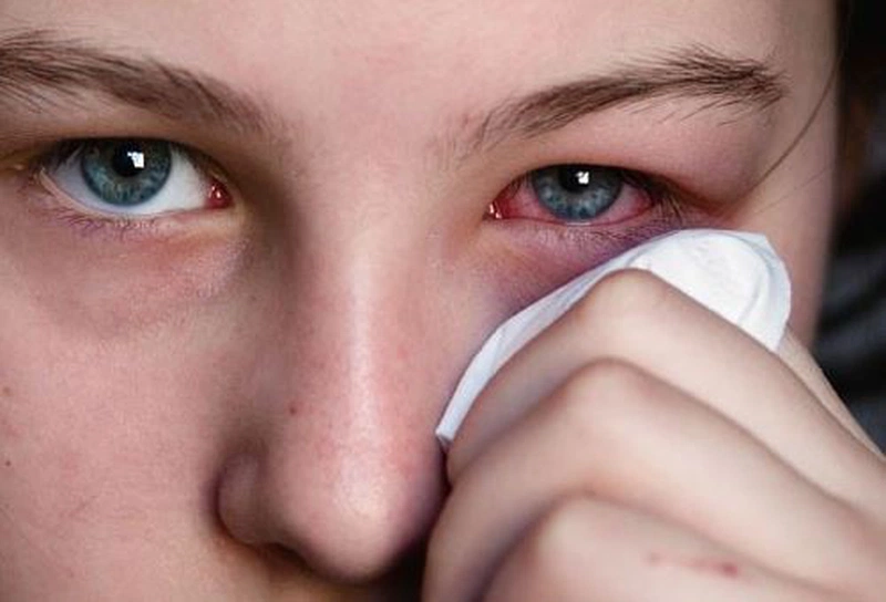 Sự khác nhau giữa đau mắt đỏ và đau mắt hột mà không phải ai cũng biết 1